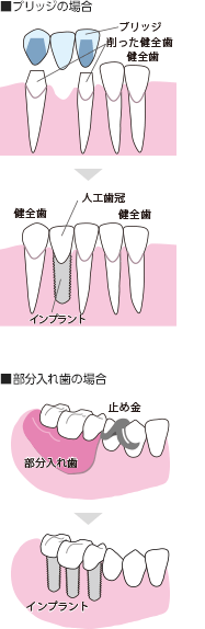 インプラント治療とは