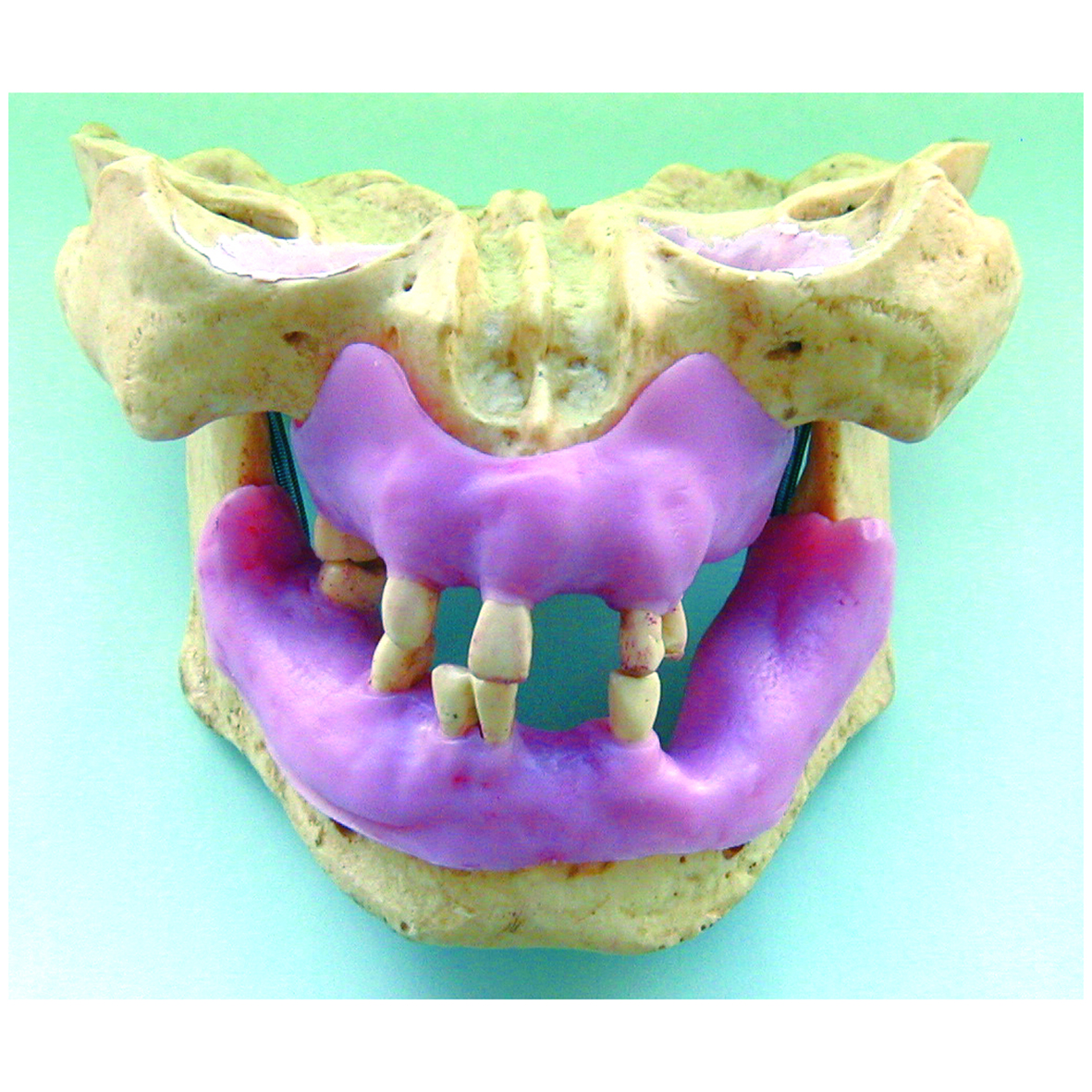 【在庫限り】#210 実習模型上下顎部分欠損歯肉付